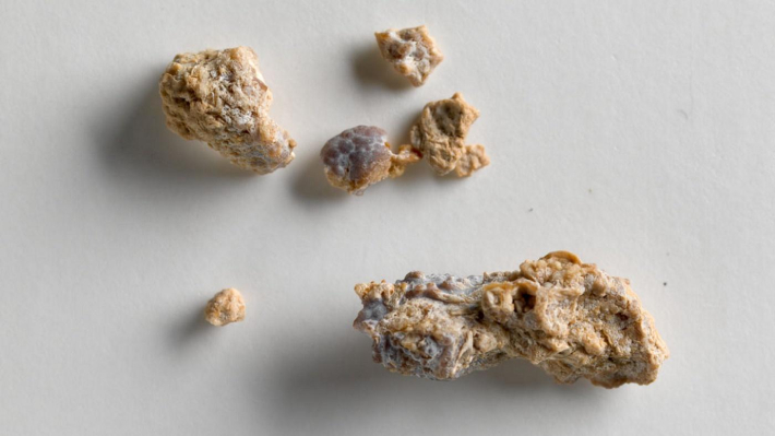 110 Kiloluk Hastaya Kapalı Böbrek Taşı Ameliyatı Yapıldı